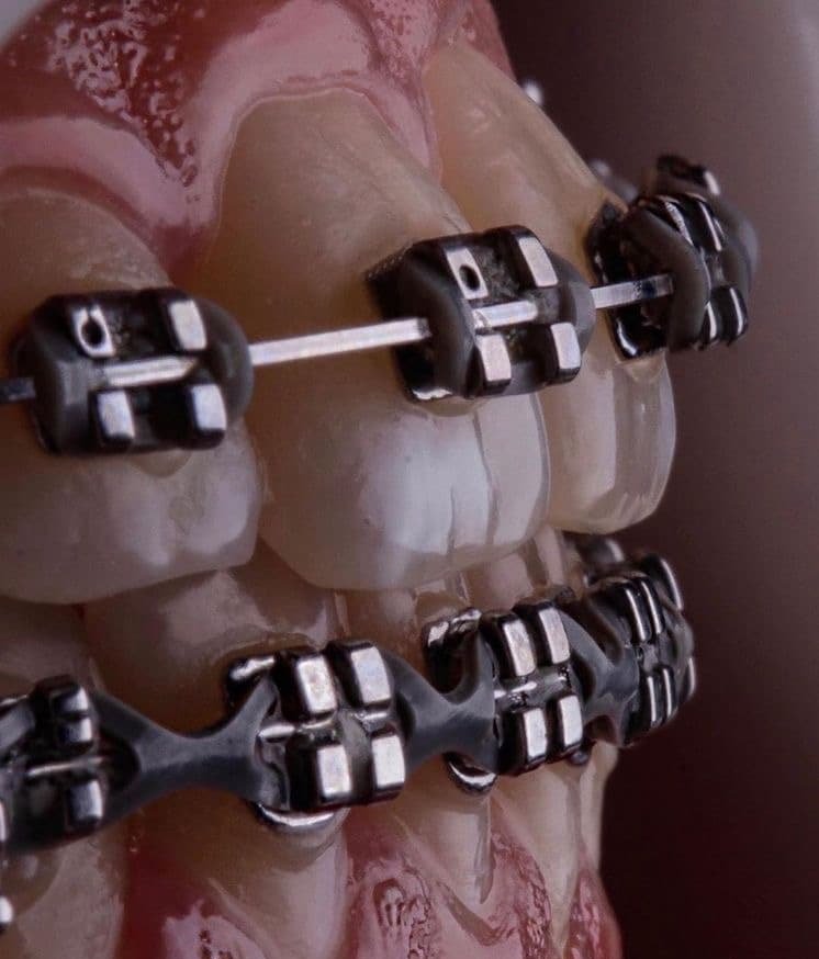 Orthodontic-braces