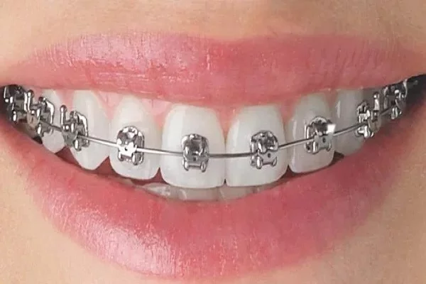 Girl smiling with orthodontic braces on her teeth