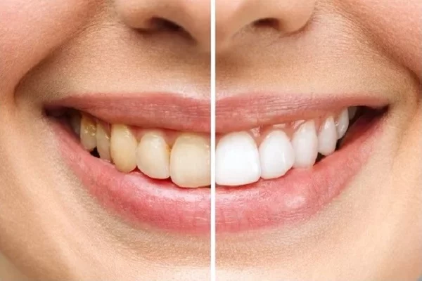 Before after comparesation of teeth whitening result